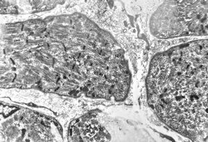 M,5y. | rhabdomyosarcoma vestibuli oris